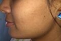 SOHAM SKIN CLINIC ( ICE TREATMENT ) - Feature Photo