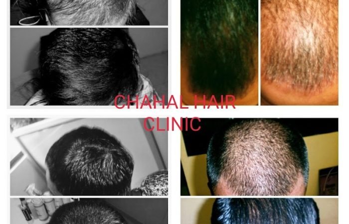 Chahal hair Clinic - Feature Photo