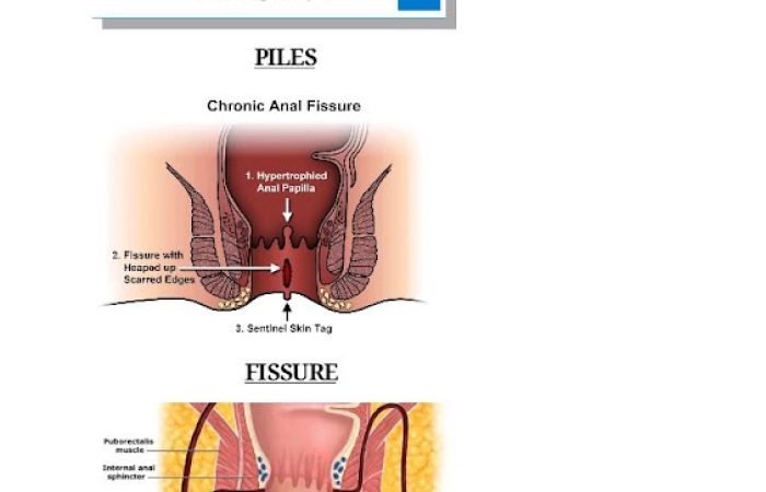 Dr. Ashish Sachdeva, M.S. | Best Anorectal Surgeon | Laser Piles/Fistula | ZSR Circumcision | Cashless Surgery | OPD ₹100 - Feature Photo