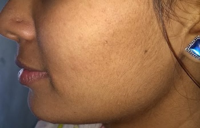 SOHAM SKIN CLINIC ( ICE TREATMENT ) - Feature Photo